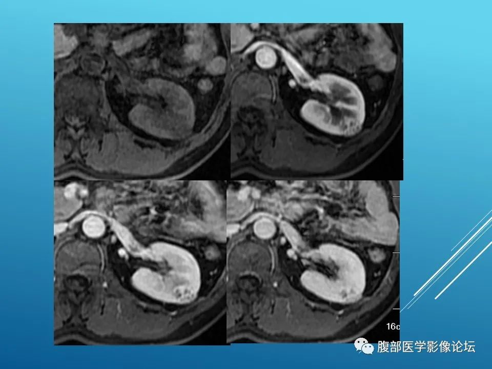 影像PPT - 【病例】肾脏透明细胞癌1例MR影像-8