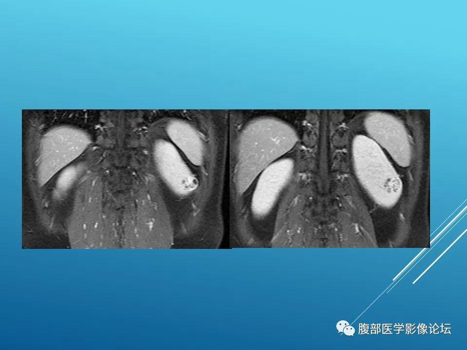 影像PPT - 【病例】肾脏透明细胞癌1例MR影像-9