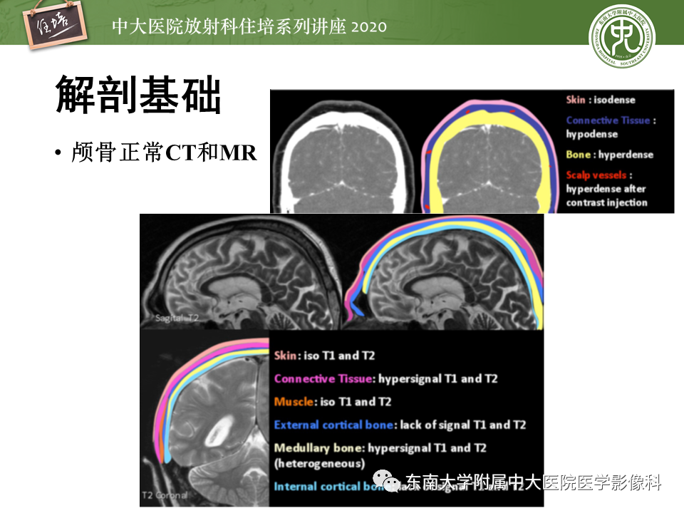 影像PPT - 【PPT】颅骨病变的影像诊断-5