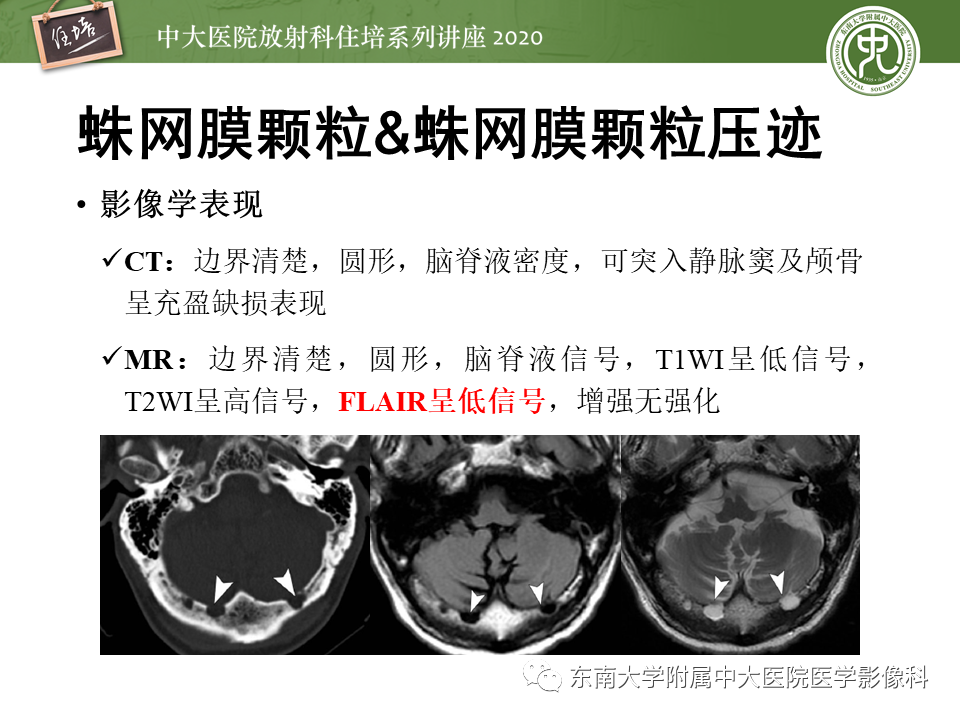 影像PPT - 【PPT】颅骨病变的影像诊断-14