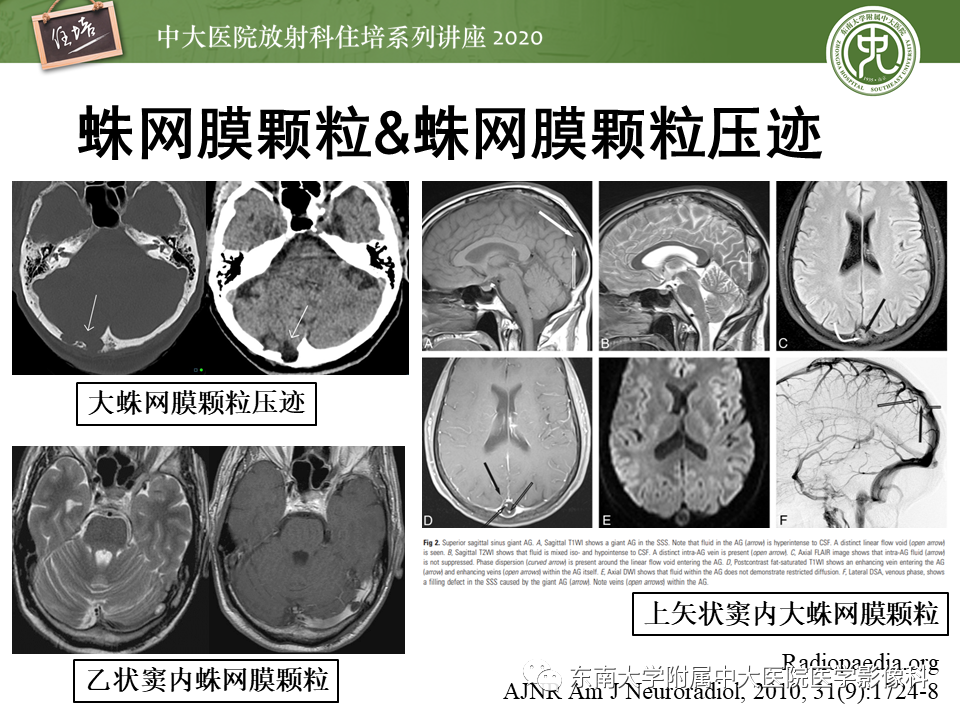 影像PPT - 【PPT】颅骨病变的影像诊断-15