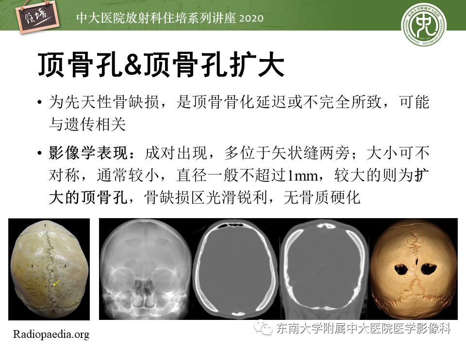 影像PPT - 【PPT】颅骨病变的影像诊断-16