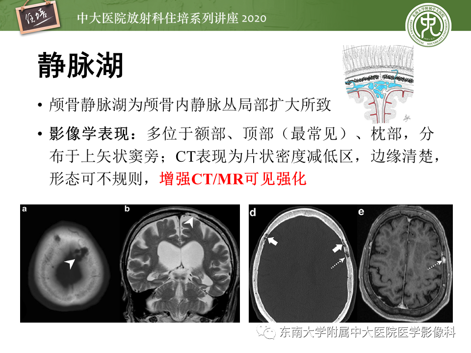影像PPT - 【PPT】颅骨病变的影像诊断-17