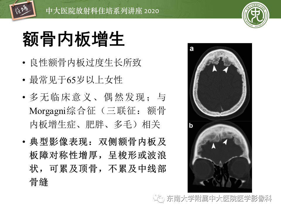 影像PPT - 【PPT】颅骨病变的影像诊断-18