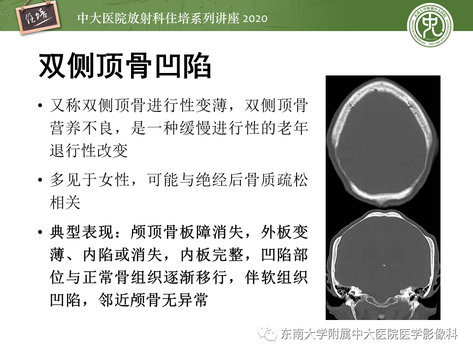 影像PPT - 【PPT】颅骨病变的影像诊断-19