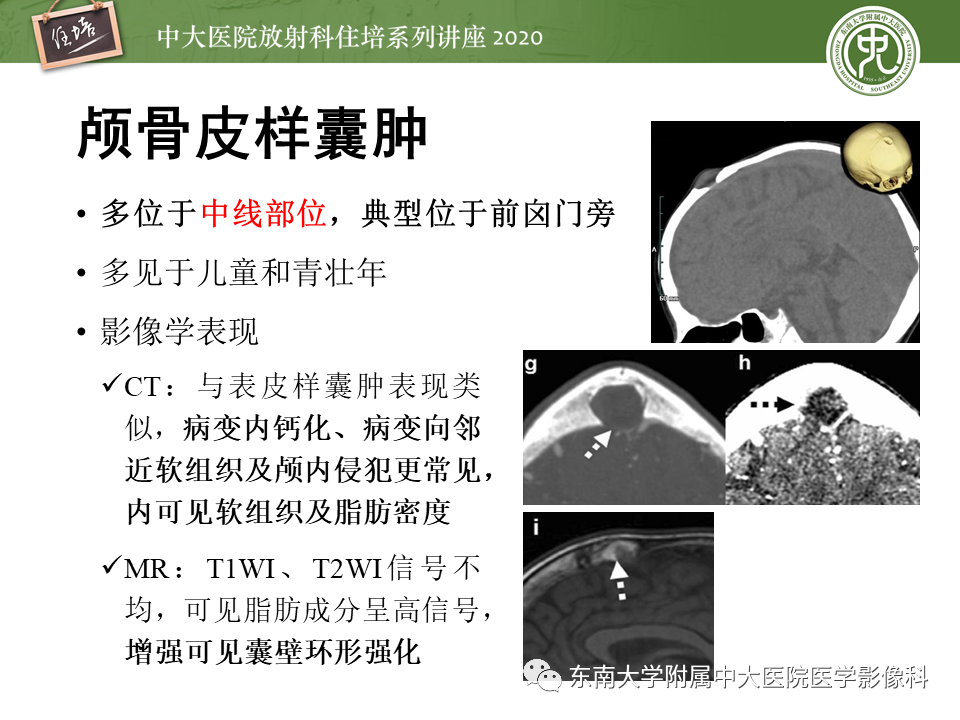 影像PPT - 【PPT】颅骨病变的影像诊断-24