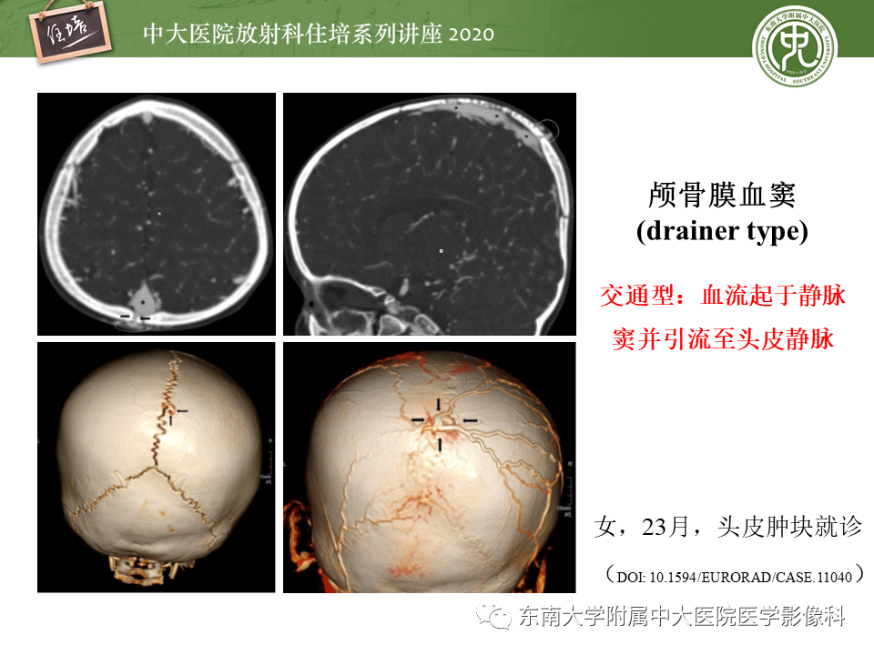 影像PPT - 【PPT】颅骨病变的影像诊断-27
