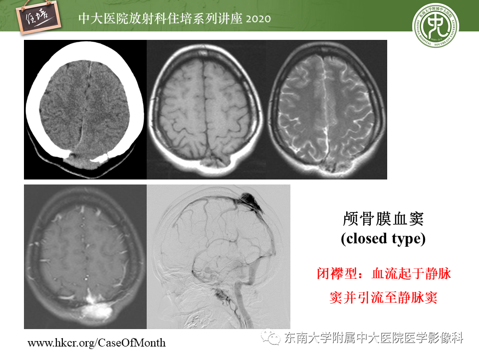 影像PPT - 【PPT】颅骨病变的影像诊断-28