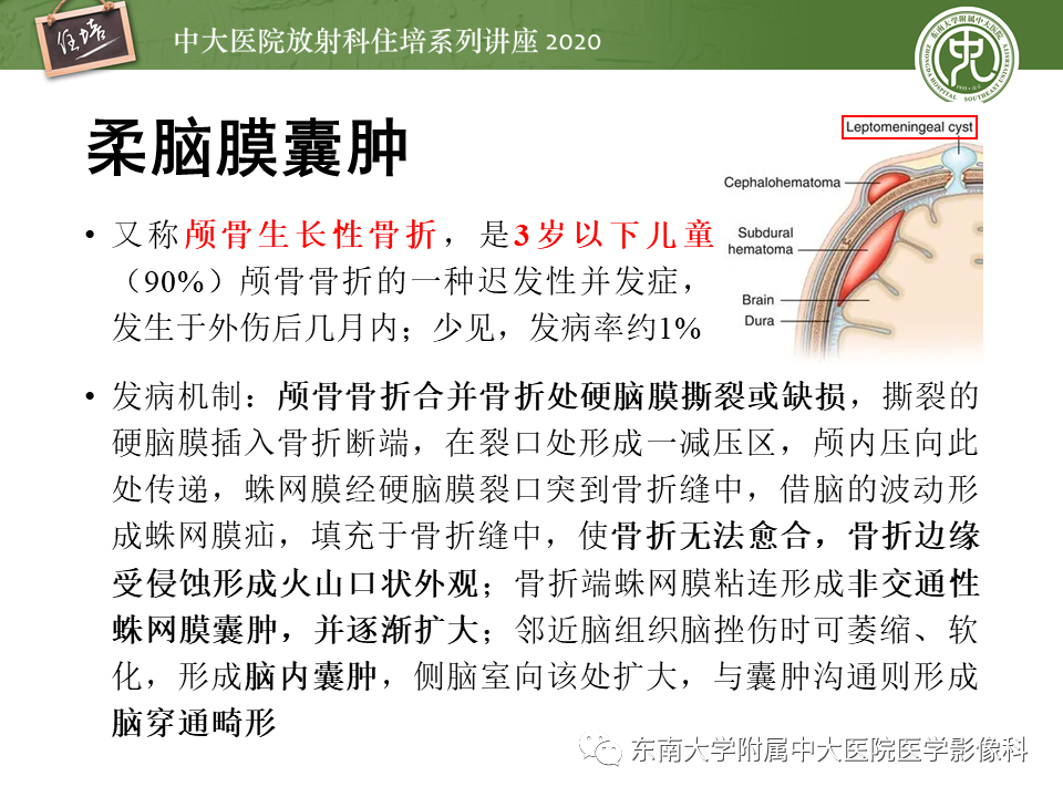影像PPT - 【PPT】颅骨病变的影像诊断-30
