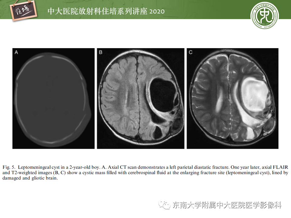 影像PPT - 【PPT】颅骨病变的影像诊断-33