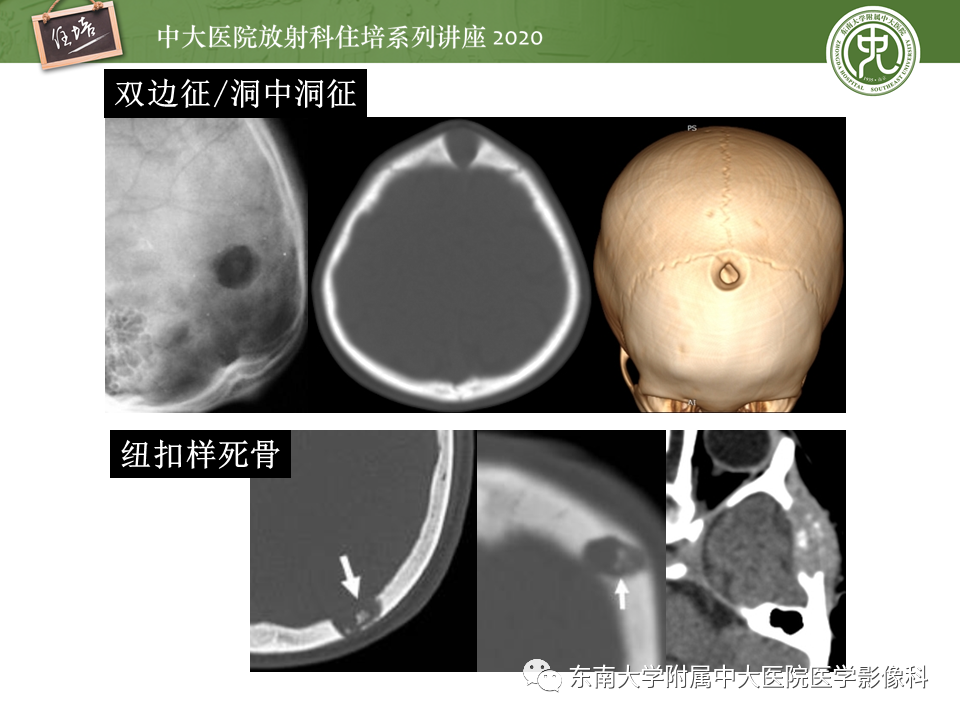 影像PPT - 【PPT】颅骨病变的影像诊断-38