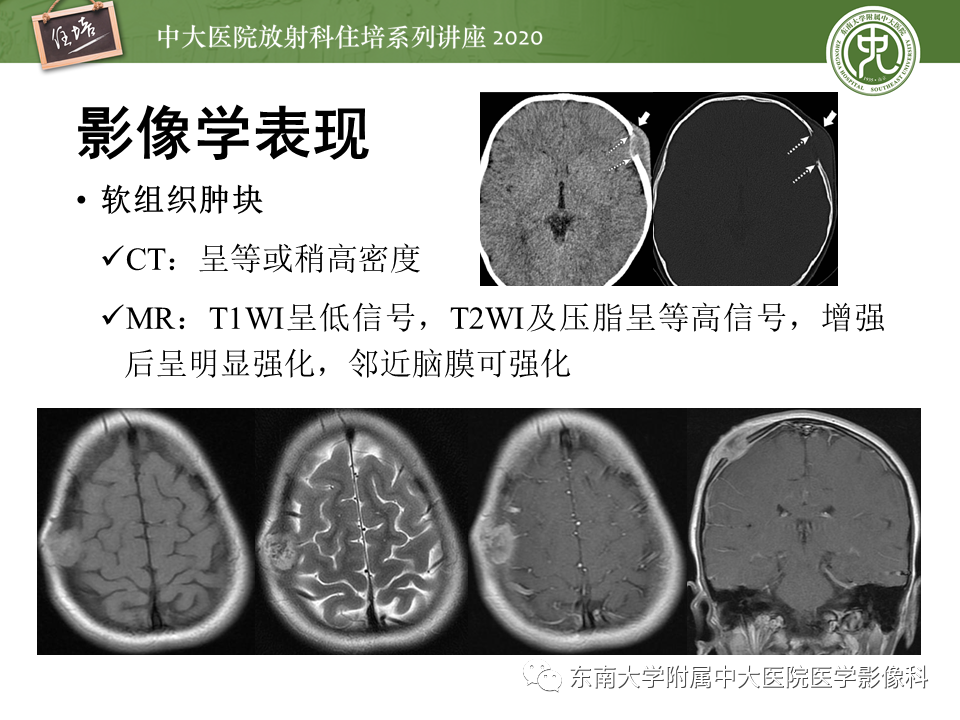 影像PPT - 【PPT】颅骨病变的影像诊断-39
