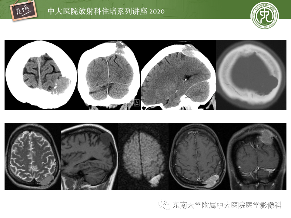 影像PPT - 【PPT】颅骨病变的影像诊断-41