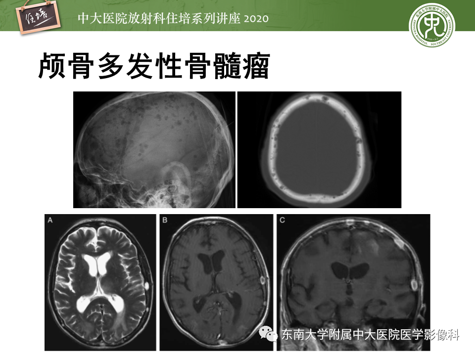 影像PPT - 【PPT】颅骨病变的影像诊断-42