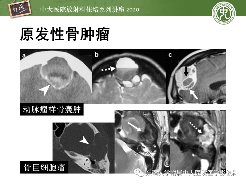 影像PPT - 【PPT】颅骨病变的影像诊断-43