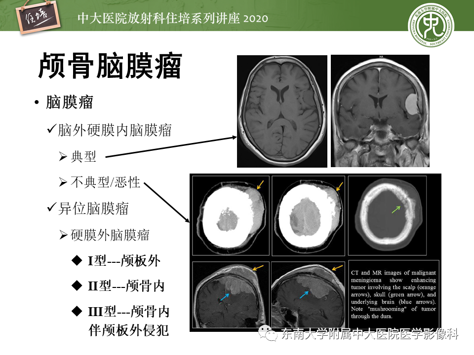 影像PPT - 【PPT】颅骨病变的影像诊断-48