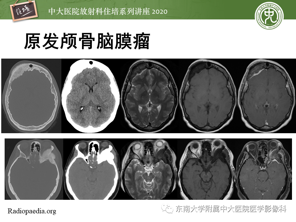 影像PPT - 【PPT】颅骨病变的影像诊断-49