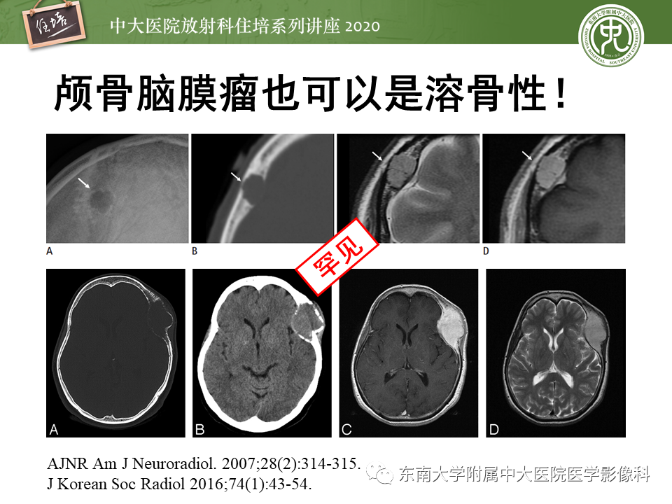 影像PPT - 【PPT】颅骨病变的影像诊断-50