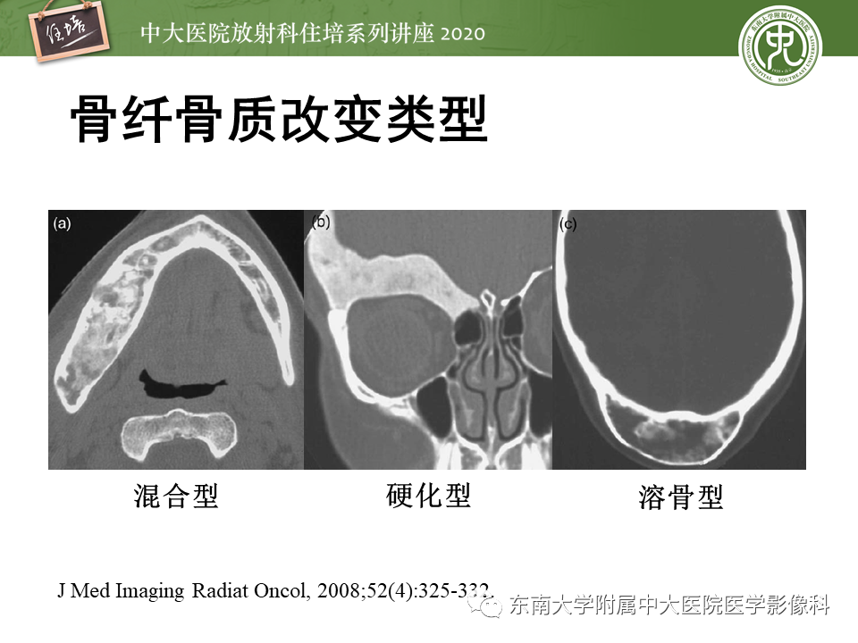影像PPT - 【PPT】颅骨病变的影像诊断-52