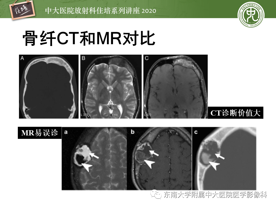 影像PPT - 【PPT】颅骨病变的影像诊断-53