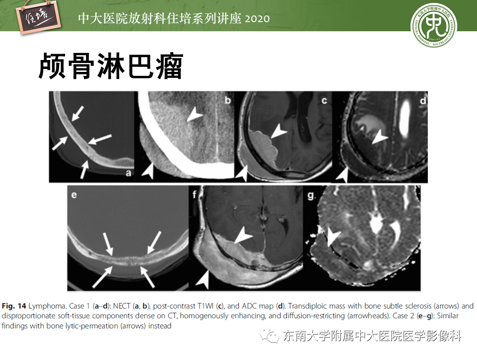 影像PPT - 【PPT】颅骨病变的影像诊断-55