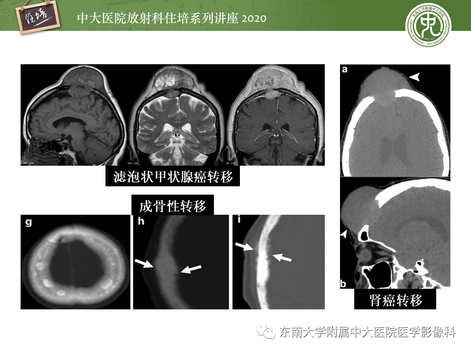 影像PPT - 【PPT】颅骨病变的影像诊断-57