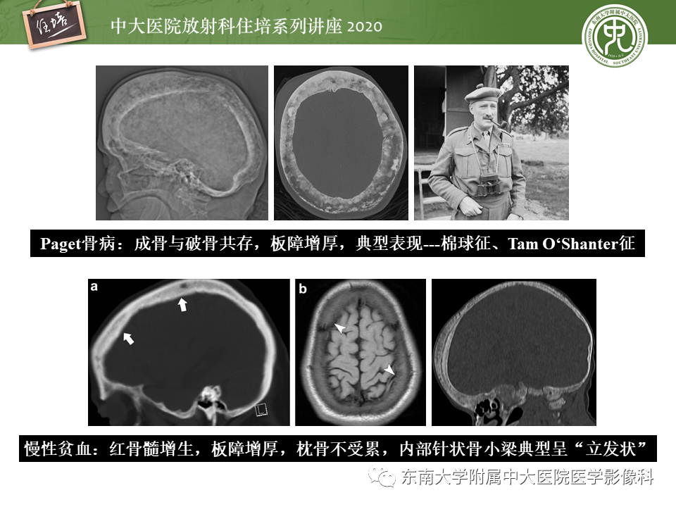 影像PPT - 【PPT】颅骨病变的影像诊断-59