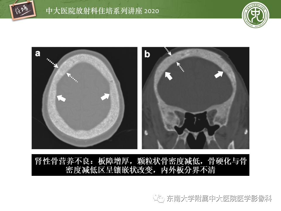 影像PPT - 【PPT】颅骨病变的影像诊断-60