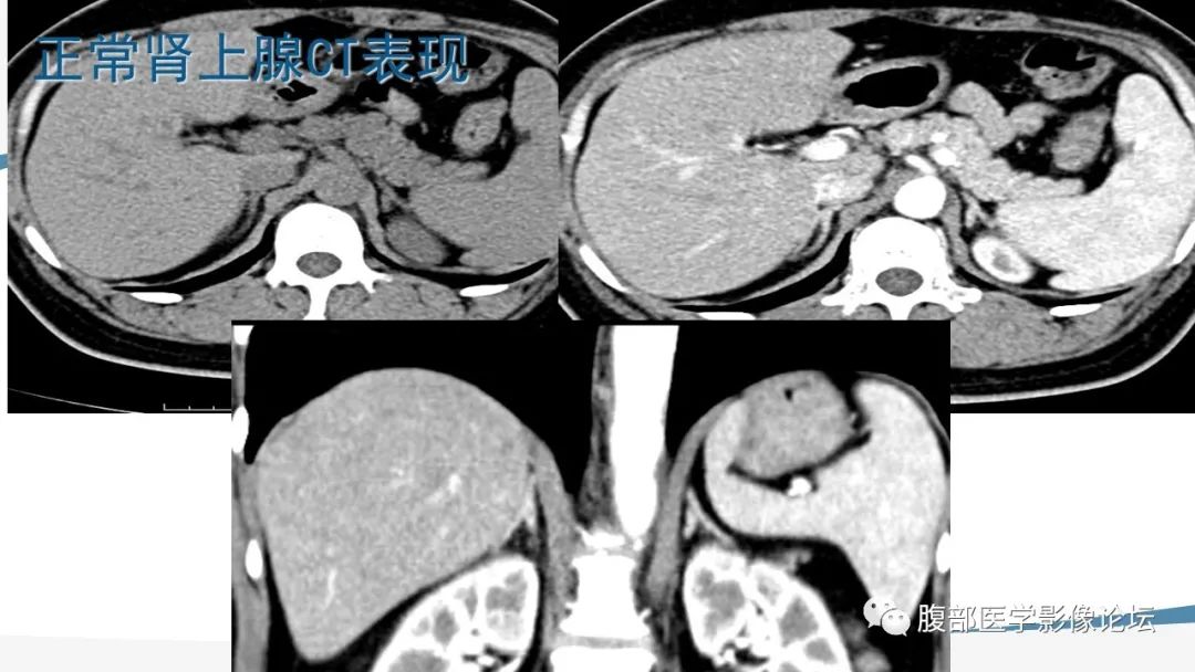 影像PPT - 【PPT】放射科在肾上腺疾病临床诊治中的作用-10