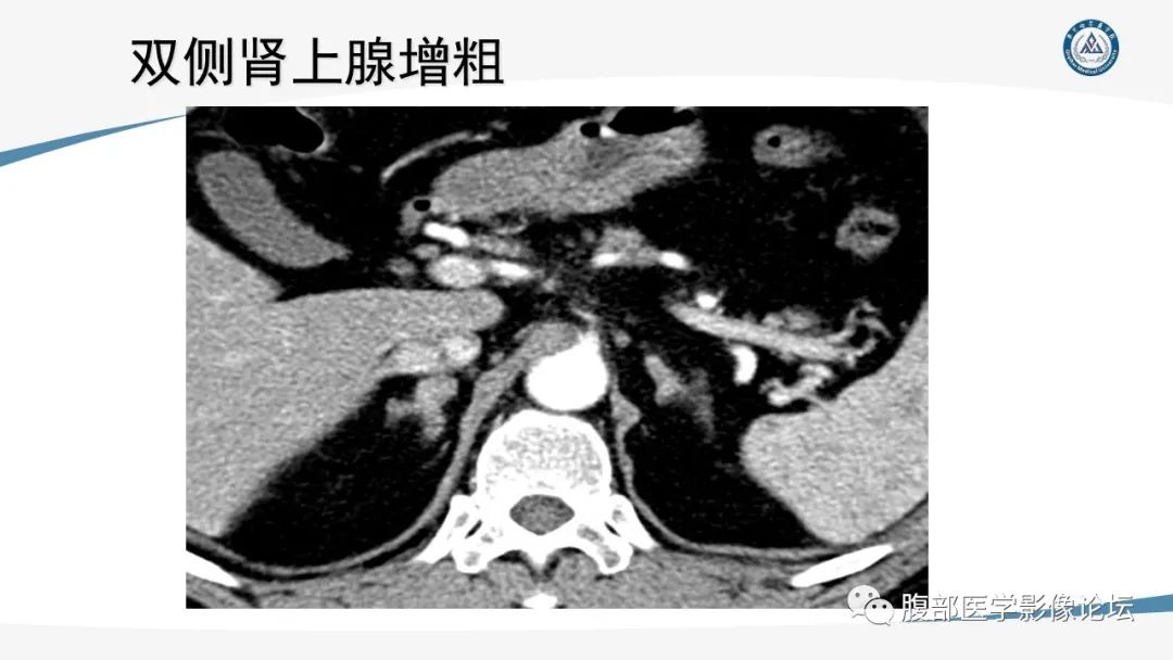 影像PPT - 【PPT】放射科在肾上腺疾病临床诊治中的作用-28