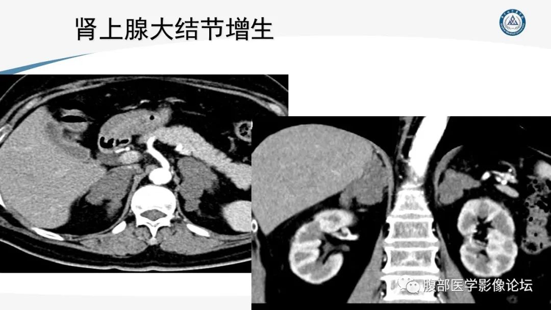 影像PPT - 【PPT】放射科在肾上腺疾病临床诊治中的作用-30