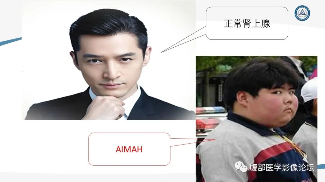 影像PPT - 【PPT】放射科在肾上腺疾病临床诊治中的作用-31