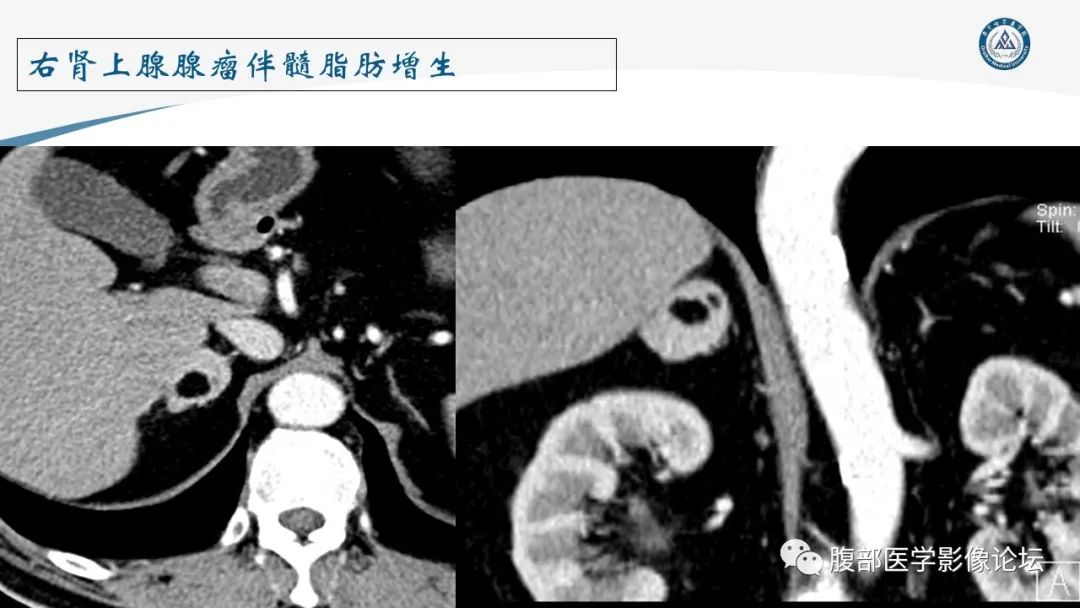 影像PPT - 【PPT】放射科在肾上腺疾病临床诊治中的作用-36