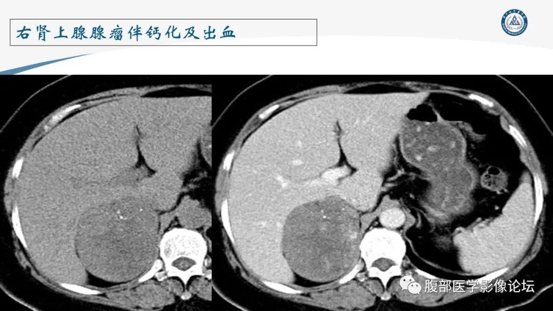 影像PPT - 【PPT】放射科在肾上腺疾病临床诊治中的作用-37
