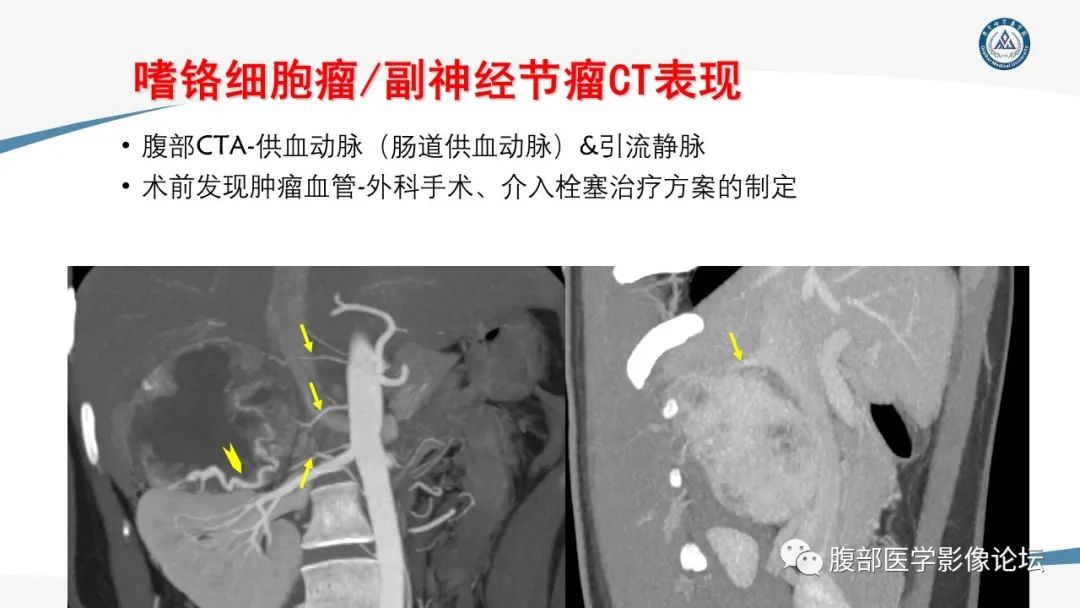 影像PPT - 【PPT】放射科在肾上腺疾病临床诊治中的作用-44
