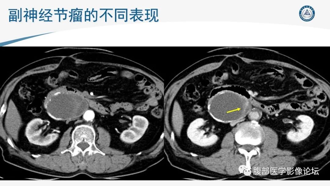 影像PPT - 【PPT】放射科在肾上腺疾病临床诊治中的作用-48