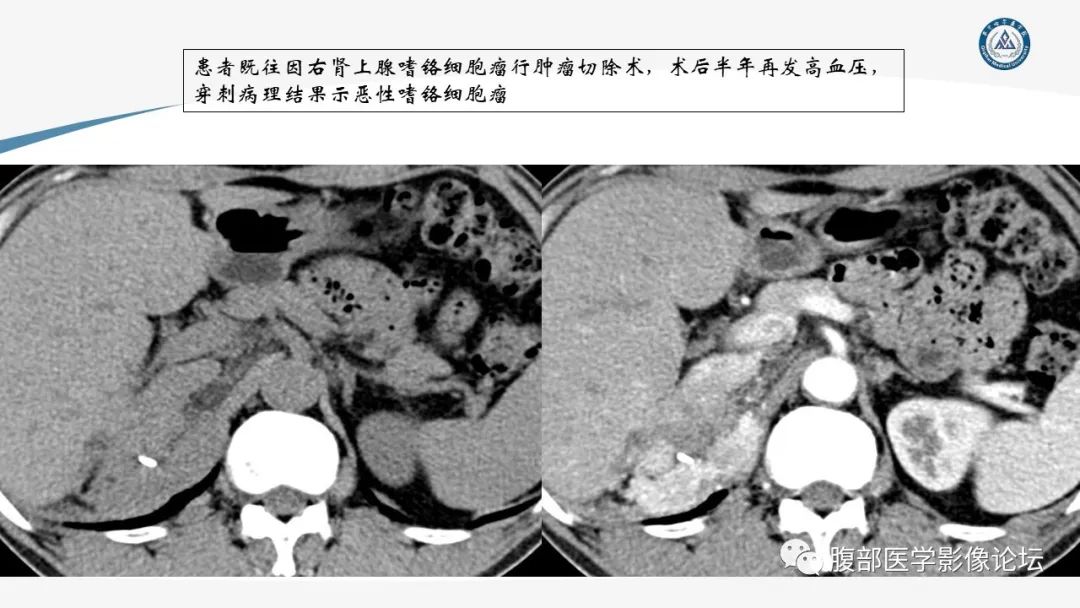 影像PPT - 【PPT】放射科在肾上腺疾病临床诊治中的作用-50