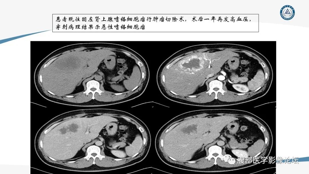 影像PPT - 【PPT】放射科在肾上腺疾病临床诊治中的作用-51