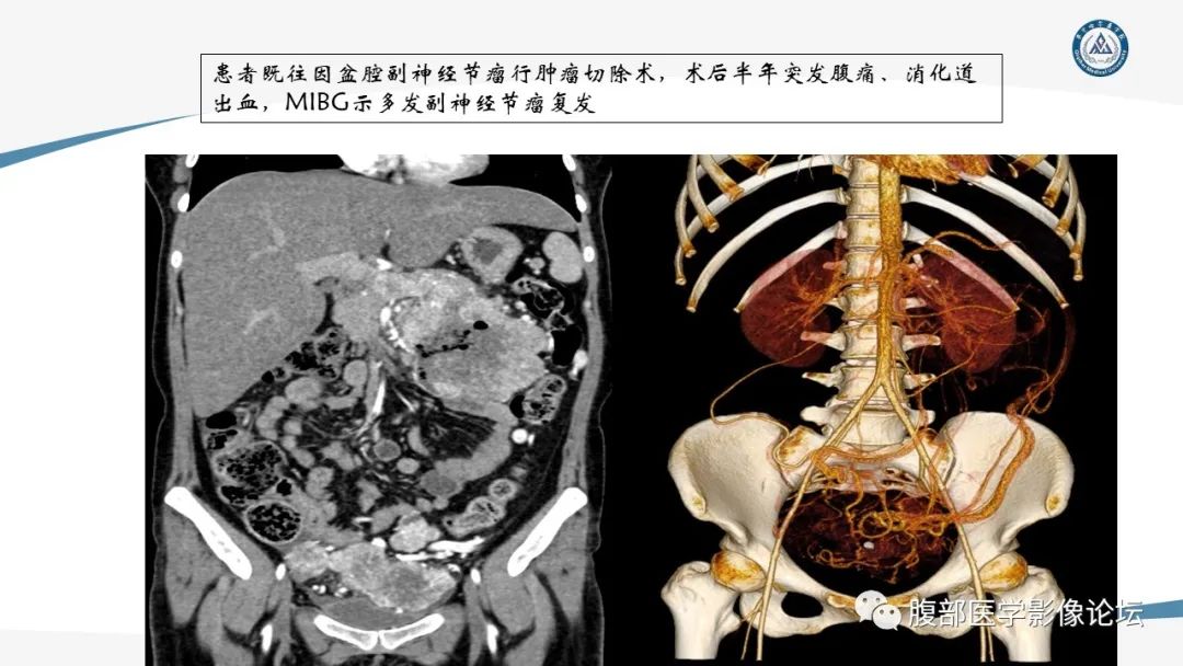 影像PPT - 【PPT】放射科在肾上腺疾病临床诊治中的作用-53