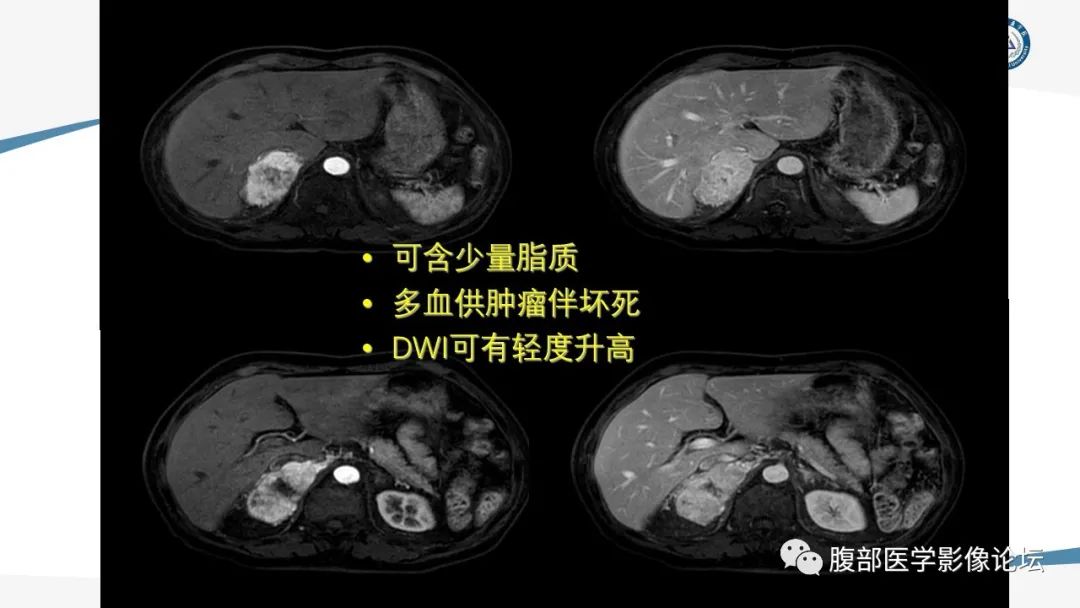 影像PPT - 【PPT】放射科在肾上腺疾病临床诊治中的作用-55
