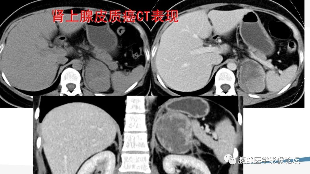 影像PPT - 【PPT】放射科在肾上腺疾病临床诊治中的作用-60