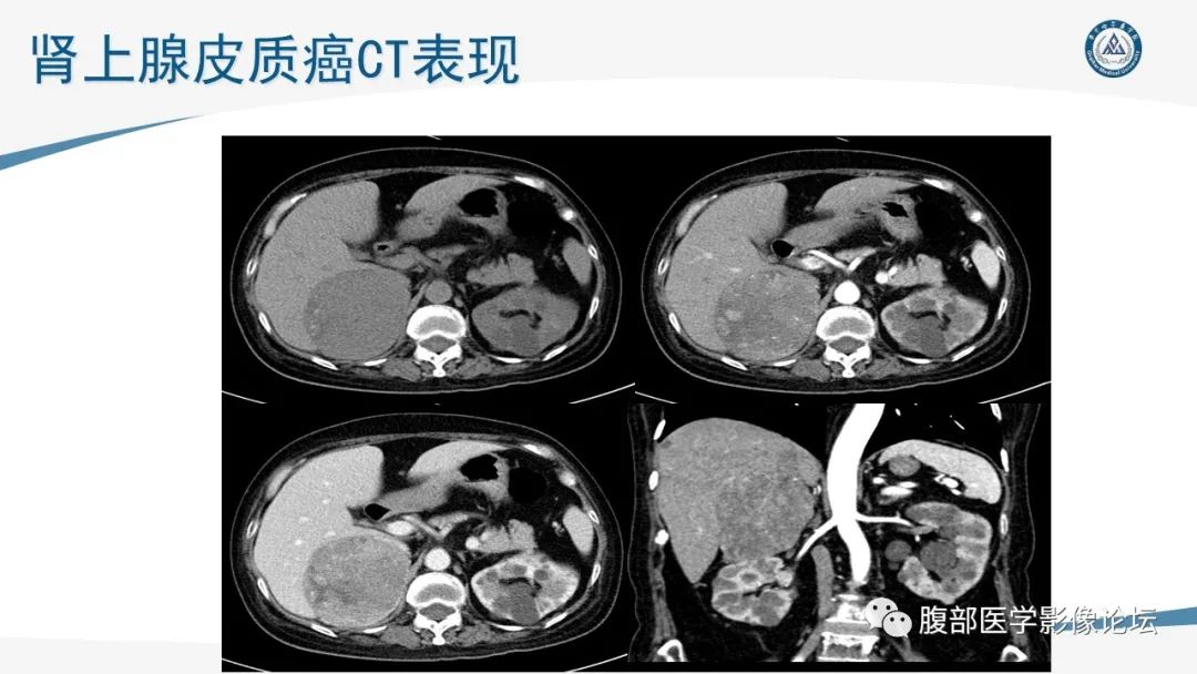 影像PPT - 【PPT】放射科在肾上腺疾病临床诊治中的作用-61