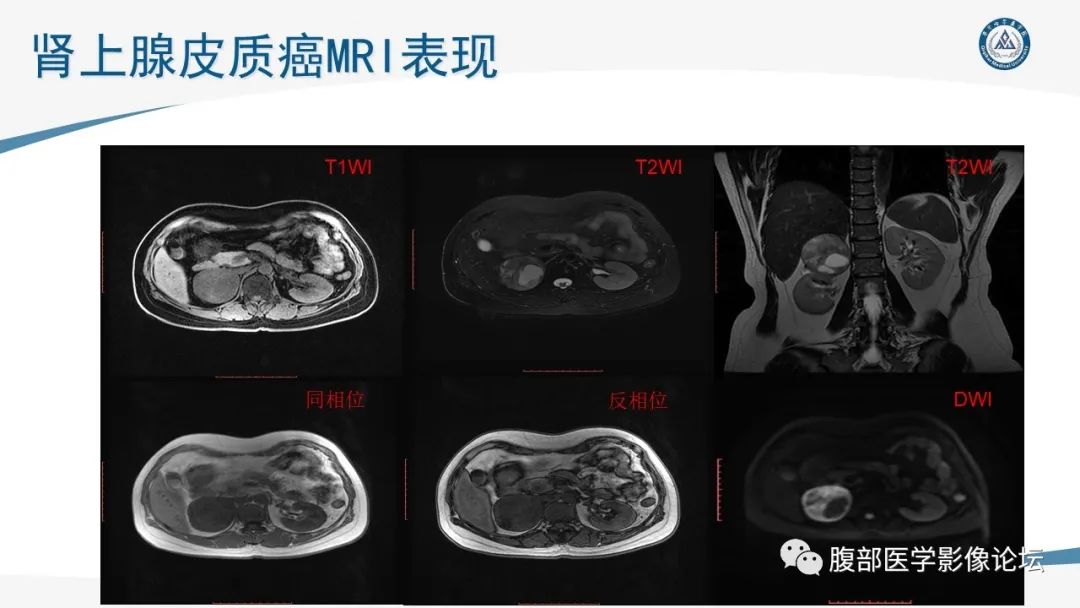 影像PPT - 【PPT】放射科在肾上腺疾病临床诊治中的作用-63