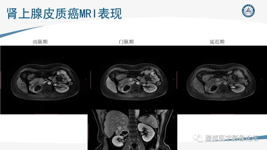 影像PPT - 【PPT】放射科在肾上腺疾病临床诊治中的作用-64