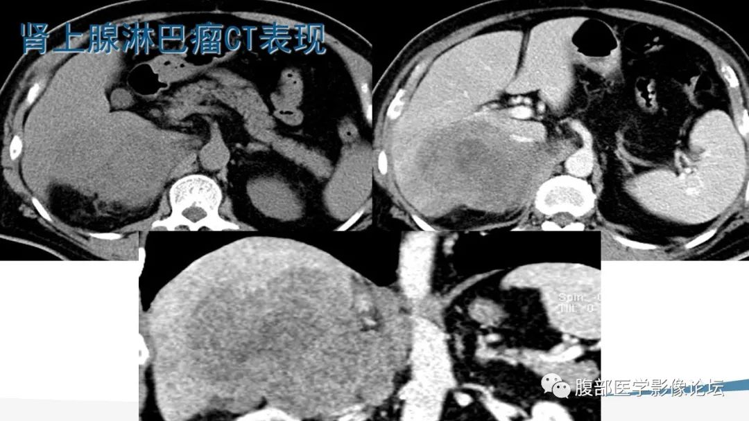 影像PPT - 【PPT】放射科在肾上腺疾病临床诊治中的作用-69