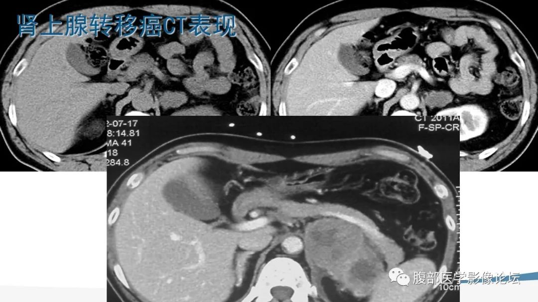 影像PPT - 【PPT】放射科在肾上腺疾病临床诊治中的作用-72