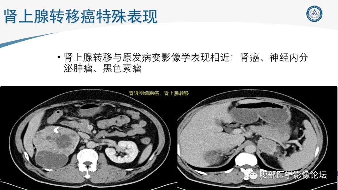 影像PPT - 【PPT】放射科在肾上腺疾病临床诊治中的作用-74