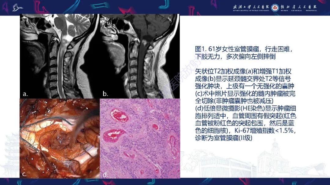 影像PPT - 【PPT】脊髓髓内占位影像诊断-10