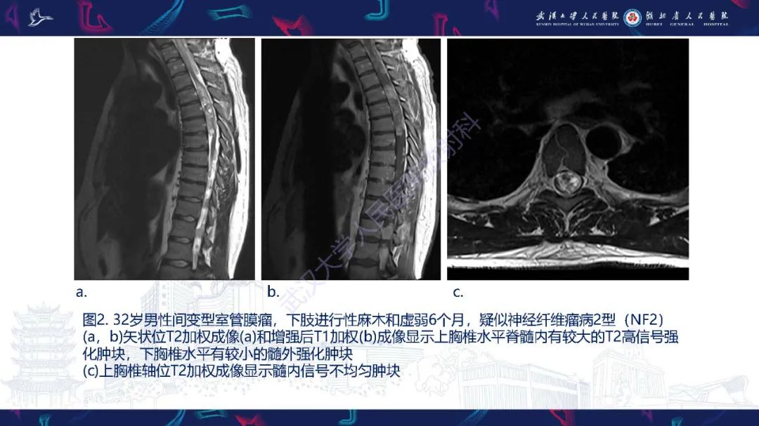 影像PPT - 【PPT】脊髓髓内占位影像诊断-12