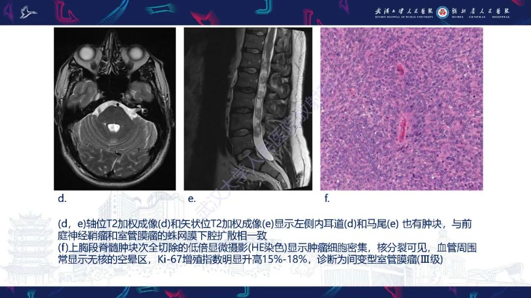 影像PPT - 【PPT】脊髓髓内占位影像诊断-13